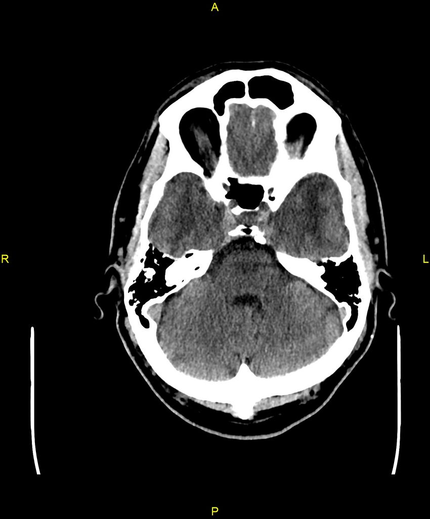 Cerebral autosomal dominant arteriopathy with subcortical infarcts and leukoencephalopathy (CADASIL) (Radiopaedia 86108-102051 Axial non-contrast 28).jpg