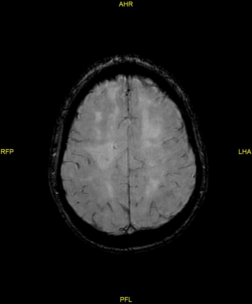 Cerebral autosomal dominant arteriopathy with subcortical infarcts and leukoencephalopathy (CADASIL) (Radiopaedia 86108-102054 Axial SWI 79).jpg
