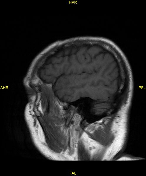 File:Cerebral autosomal dominant arteriopathy with subcortical infarcts and leukoencephalopathy (CADASIL) (Radiopaedia 86108-102054 Sagittal T1 23).jpg