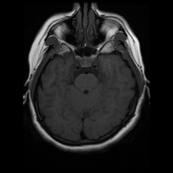 File:Cerebral cavernous malformation (Radiopaedia 44301-47942 Axial T1 7).jpg