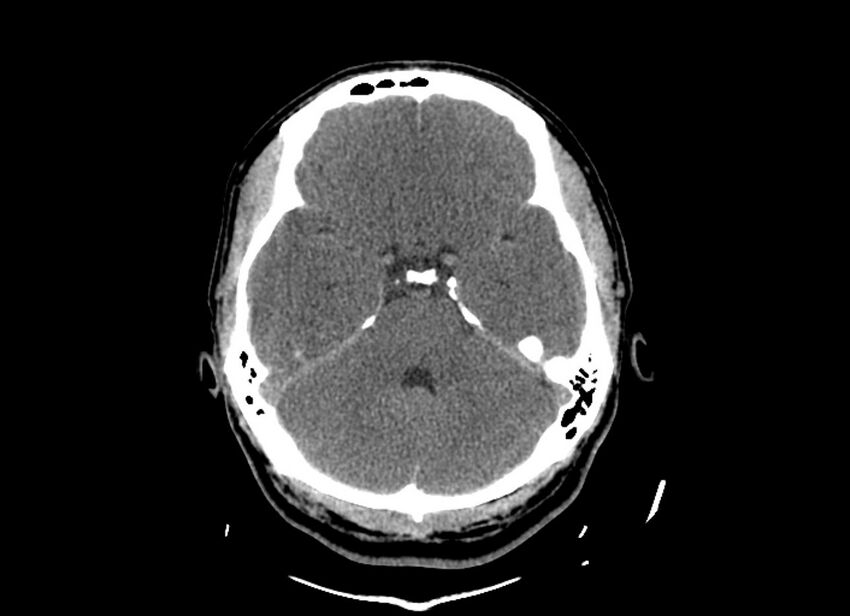 Cerebral edema (Radiopaedia 82519-96661 Axial non-contrast 38).jpg