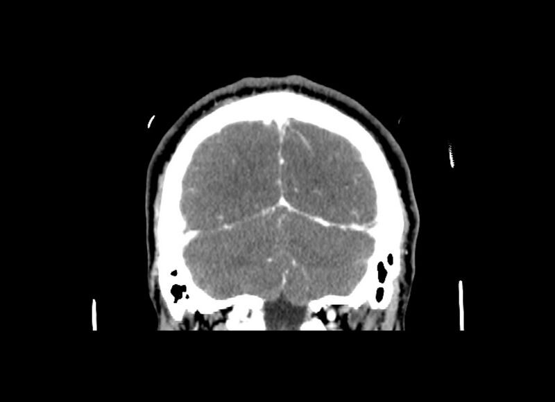 File:Cerebral edema (Radiopaedia 82519-96661 C 16).jpg