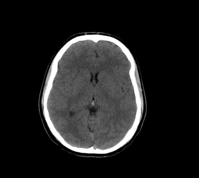 File:Cerebral fat embolism (Radiopaedia 37510-39362 Axial non-contrast 17).jpg