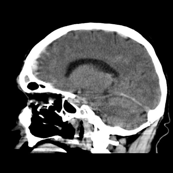 File:Cerebral hemorrhagic contusions (Radiopaedia 23145-23188 C 18).jpg