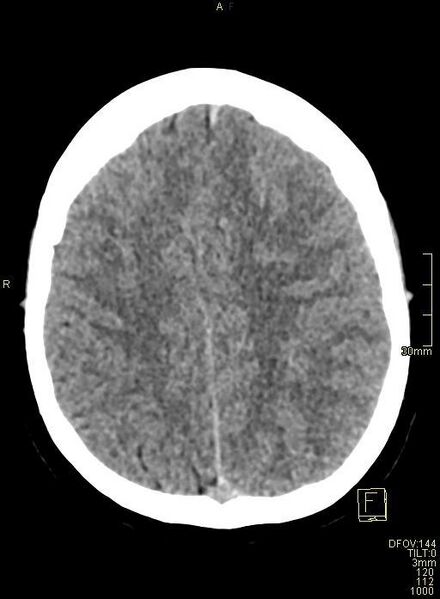 File:Cerebral venous sinus thrombosis (Radiopaedia 91329-108965 Axial non-contrast 37).jpg