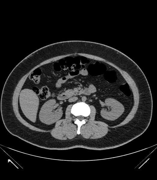 File:Cervical aortic arch with coarctation and aneurysms (Radiopaedia 44035-47552 Axial non-contrast 59).jpg