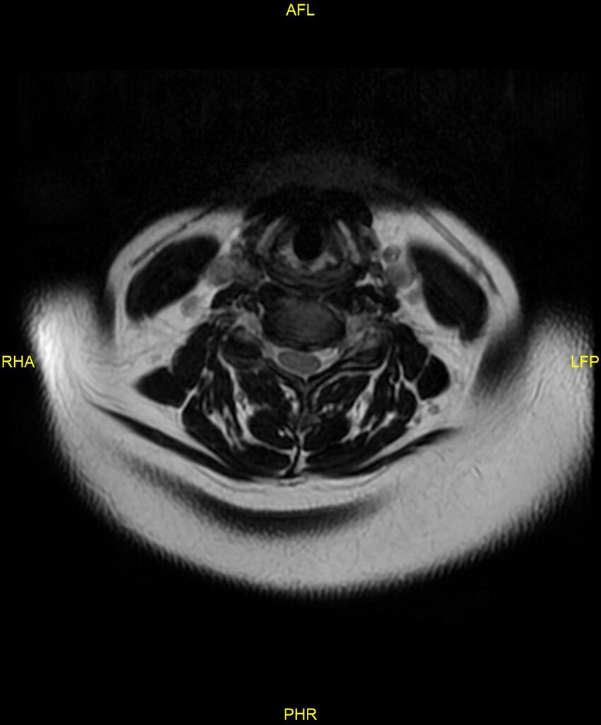 Cervical disc protrusion (Radiopaedia 87147-103415 Axial T2 20).jpg
