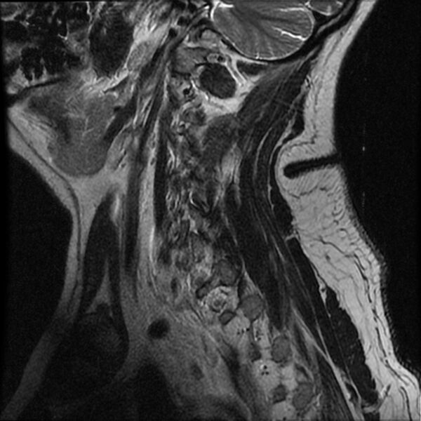 File:Cervical fracture and dislocation with locked facet (Radiopaedia 31837-32781 Sagittal T2 16).jpg