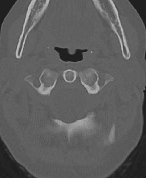 File:Cervical spine ACDF loosening (Radiopaedia 48998-54071 Axial bone window 15).png