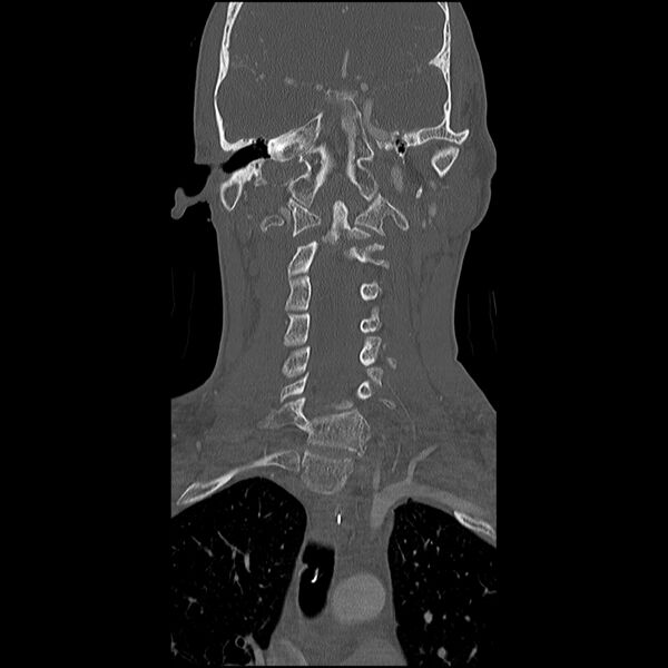 File:Cervical spine fractures with vertebral artery dissection (Radiopaedia 32135-33078 Coronal bone window 12).jpg