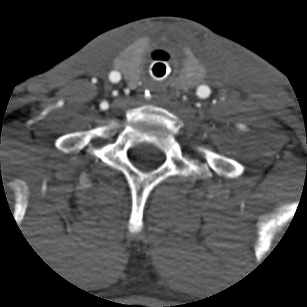 File:Cervical spine fractures with vertebral artery dissection (Radiopaedia 32135-33078 D 25).jpg