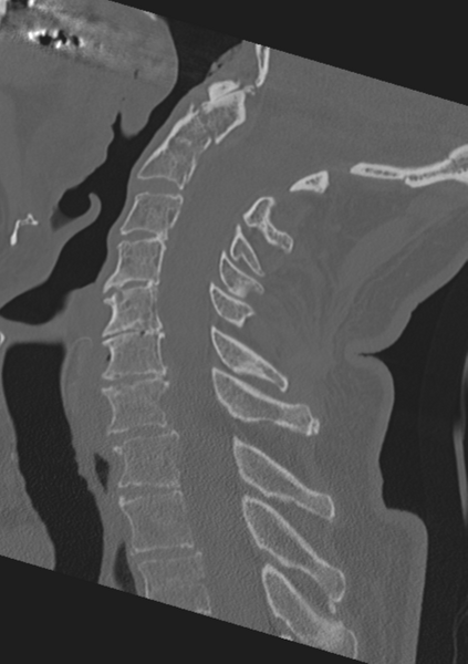 File:Cervical spine fractures with vertebral artery dissection (Radiopaedia 53296-59268 Sagittal bone window 34).png