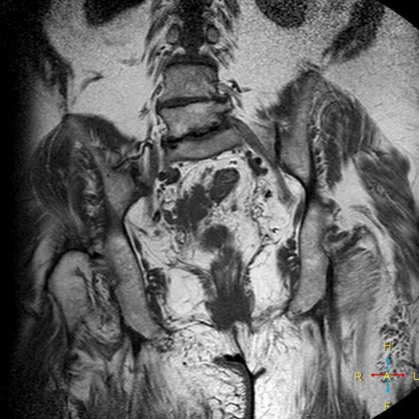 File:Cervical stump squamous cell carcinoma (Radiopaedia 48049-52858 Coronal T1 14).jpg