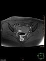 Cesarian scar endometriosis (Radiopaedia 68495-78066 Axial T1 fat sat 12).jpg