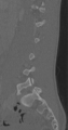 Chance fracture (Radiopaedia 40360-42912 Sagittal bone window 65).png