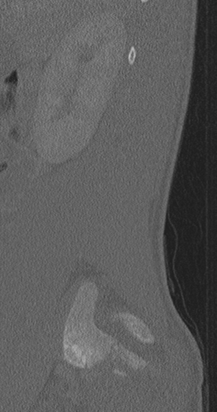 File:Chance fracture (Radiopaedia 40360-42912 Sagittal bone window 82).png