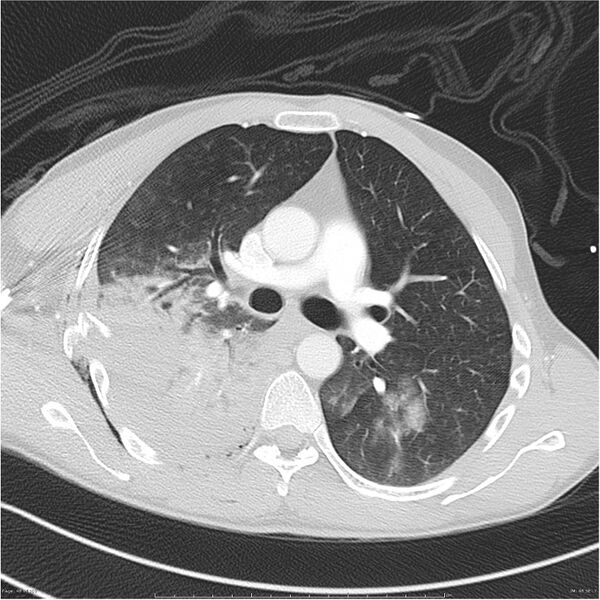 File:Chest and abdomen multi-trauma (Radiopaedia 26294-26425 lung window 48).jpg