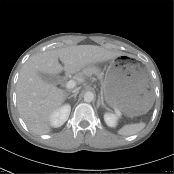 File:Chest and abdomen multi-trauma (Radiopaedia 26294-26426 bone window 24).jpg