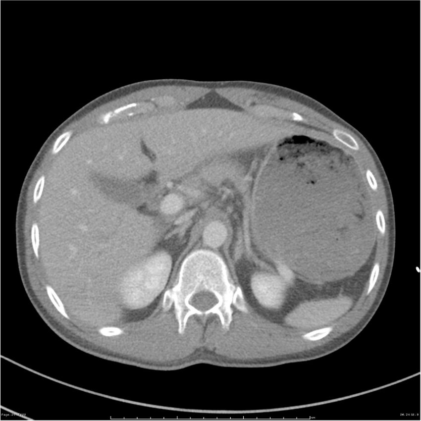 Chest and abdomen multi-trauma (Radiopaedia 26294-26426 bone window 24).jpg