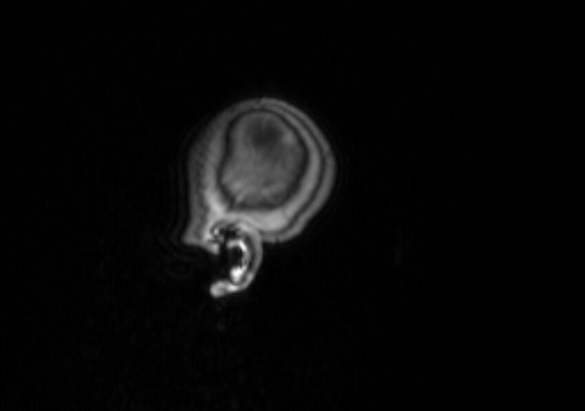 Chiari III malformation with occipital encephalocele (Radiopaedia 79446-92559 Sagittal T1 C+ mpr 61).jpg
