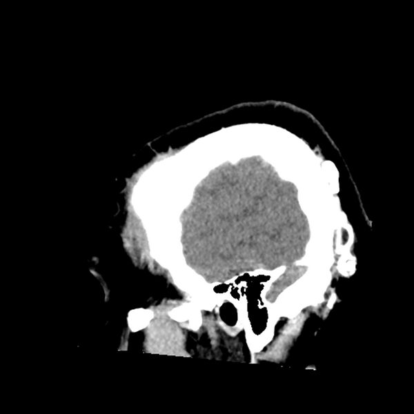 File:Chiasmatic-hypothalamic juvenile pilocytic astrocytoma (Radiopaedia 78533-91237 B 53).jpg
