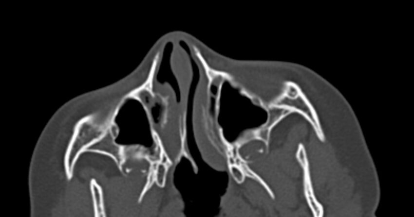 Choanal atresia (Radiopaedia 51295-56972 Axial bone window 20).jpg