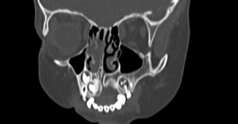 File:Choanal atresia (Radiopaedia 51295-56972 Coronal bone window 27).jpg
