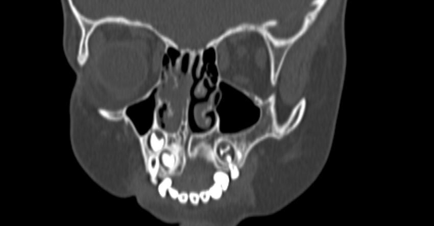 Choanal atresia (Radiopaedia 51295-56972 Coronal bone window 27).jpg