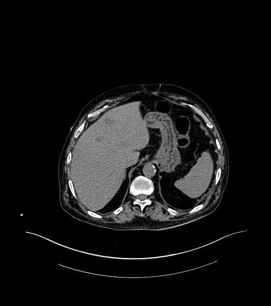 File:Cholangiocarcinoma with cerebral metastases (Radiopaedia 83519-98629 Axial non-contrast 18).jpg