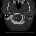 Chondroblastoma - occipital condyle (Radiopaedia 5569-7304 bone window 5).jpg