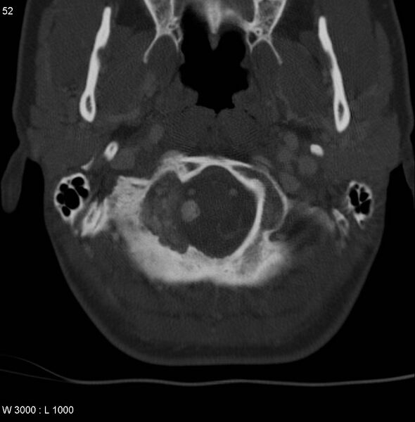 File:Chondroblastoma - occipital condyle (Radiopaedia 5569-7304 bone window 5).jpg