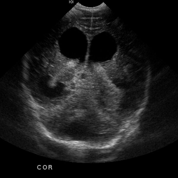 File:Choroid plexus carcinoma (Radiopaedia 21121-21033 A 4).jpg