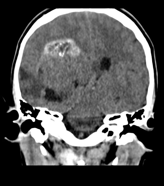 File:Choroid plexus carcinoma (Radiopaedia 91013-108552 Coronal non-contrast 50).jpg