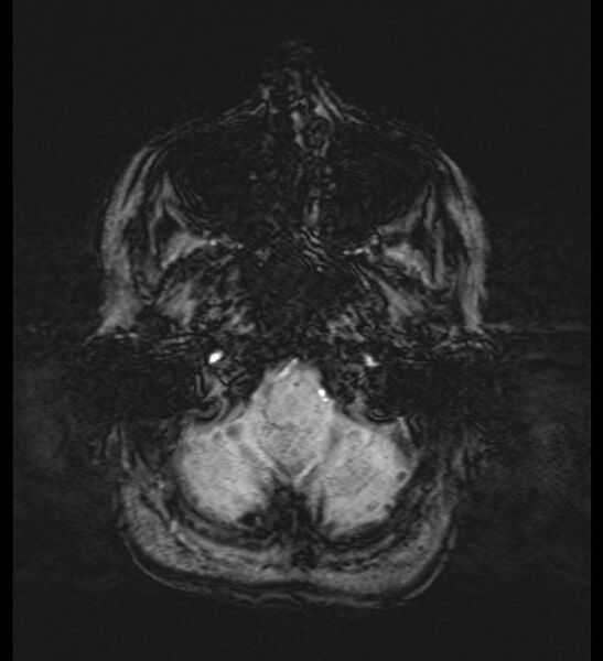File:Choroid plexus xanthogranuloma (Radiopaedia 91271-108875 Axial SWI 10).jpg