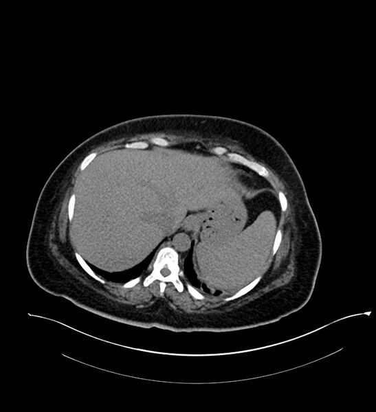 File:Chromophobe renal cell carcinoma (Radiopaedia 84239-99519 Axial non-contrast 34).jpg