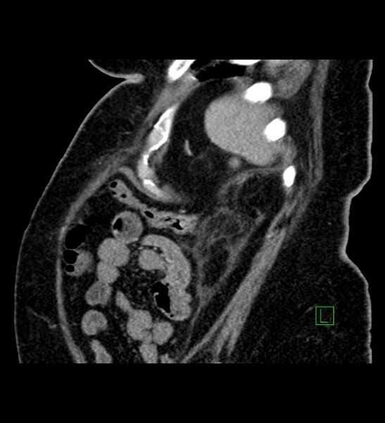 File:Chromophobe renal cell carcinoma (Radiopaedia 84239-99519 D 20).jpg