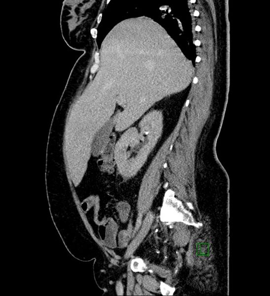 File:Chromophobe renal cell carcinoma (Radiopaedia 84239-99519 G 79).jpg