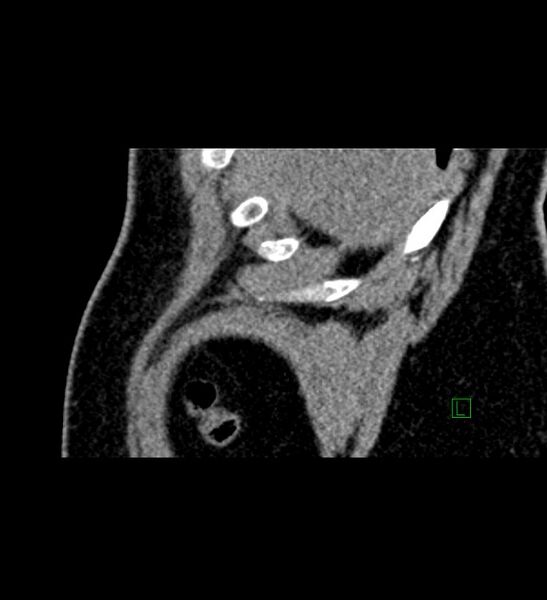 File:Chromophobe renal cell carcinoma (Radiopaedia 84286-99573 F 169).jpg