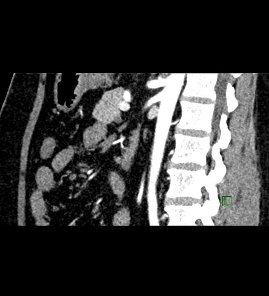 File:Chromophobe renal cell carcinoma (Radiopaedia 84286-99573 F 76).jpg