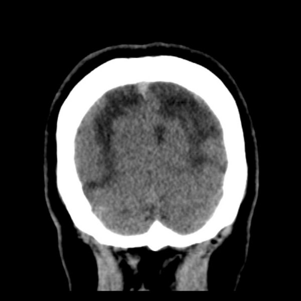 File:Chronic bilateral occipital lobe infarcts (Radiopaedia 31276-31996 Coronal non-contrast 41).jpg