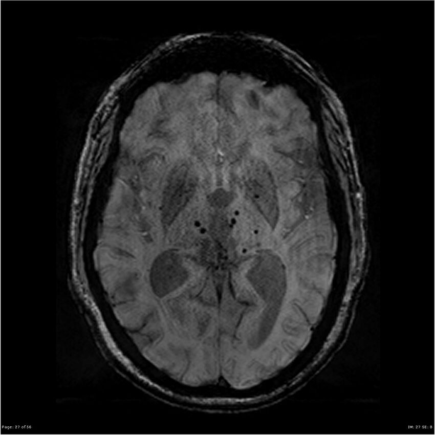 Chronic hypertensive encephalopathy (Radiopaedia 25764-25918 Axial SWI 27).jpg
