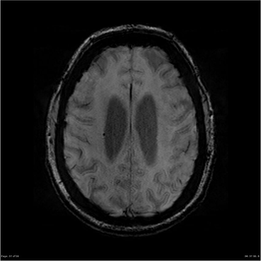 Chronic hypertensive encephalopathy (Radiopaedia 25764-25918 Axial SWI 37).jpg