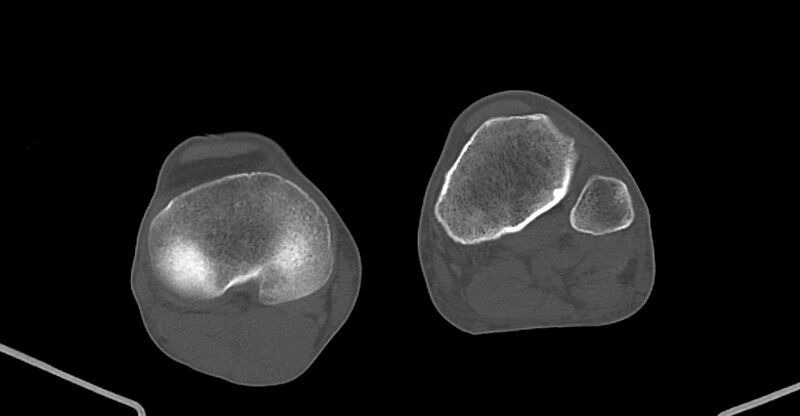 File:Chronic osteomyelitis (with sequestrum) (Radiopaedia 74813-85822 Axial non-contrast 199).jpg