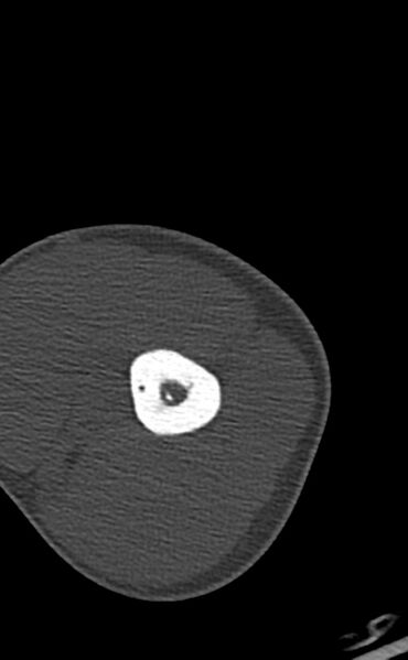 File:Chronic osteomyelitis of the distal humerus (Radiopaedia 78351-90971 Axial 61).jpg