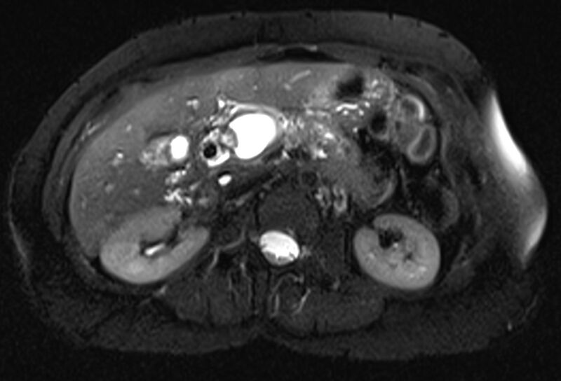 File:Chronic pancreatitis - pancreatic duct calculi (Radiopaedia 71818-82250 Axial T2 fat sat 31).jpg