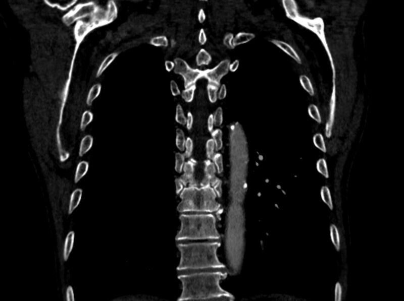 File:Chronic pulmonary embolism (Radiopaedia 91241-108843 A 90).jpg