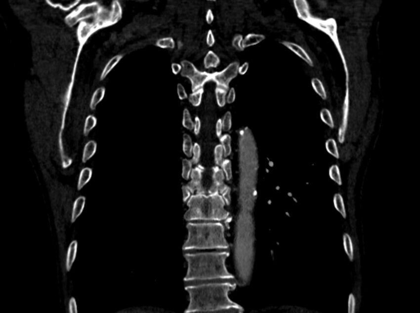 Chronic pulmonary embolism (Radiopaedia 91241-108843 A 90).jpg