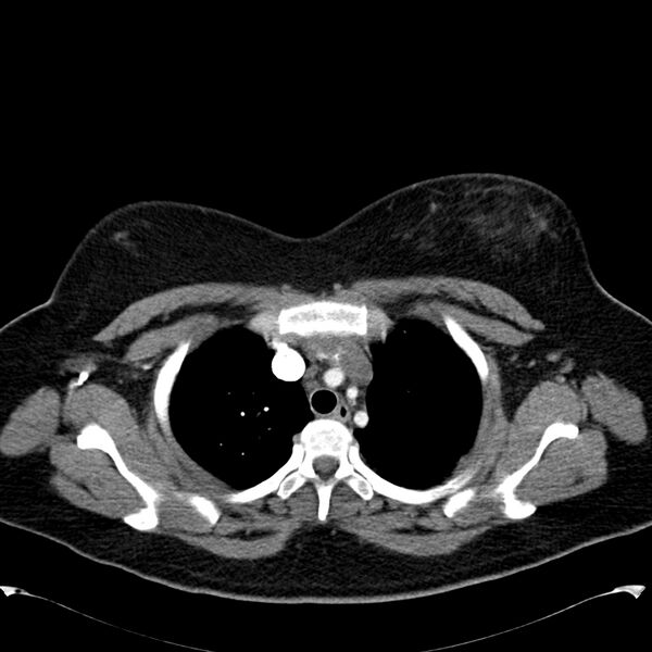 File:Chronic thromboembolic pulmonary hypertension (CTEPH) (Radiopaedia 74597-85531 Axial C+ CTPA 12).jpg