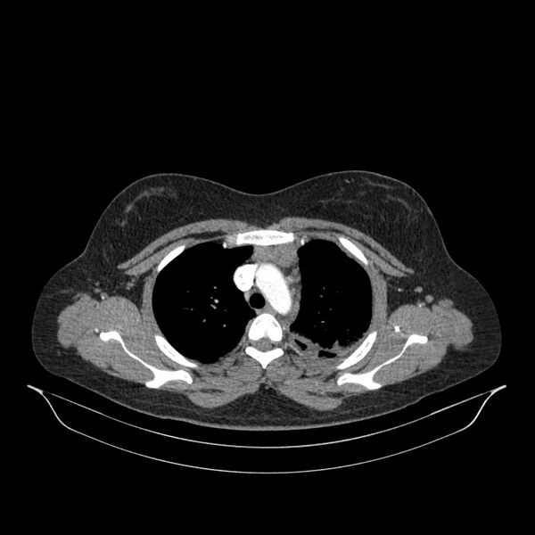 File:Chronic thromboembolic pulmonary hypertension (CTEPH) (Radiopaedia 74597-85532 Axial C+ CTPA 119).jpg