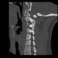 Clay-shoveler fracture (Radiopaedia 22568-22590 Sagittal bone window 30).jpg